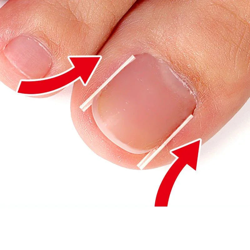 1-10 Box Elastic C-shaped Tube Padding Treatment Foot Care Invisible Groove Straightening Clip Ingrown Toenail Corrector Tools